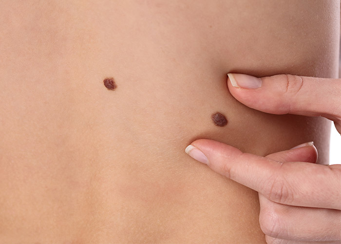 Как выглядит рак кожи: первые симптомы и признаки
