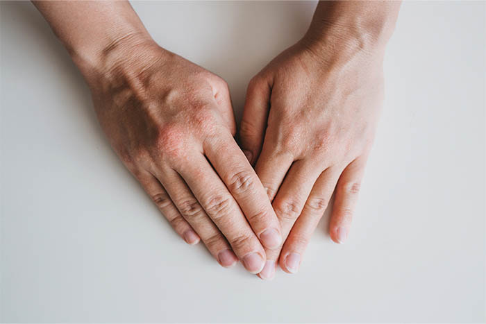 Экзема и псориаз на ладонях и стопах: отличия