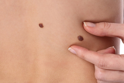 Как выглядит рак кожи: первые симптомы и признаки