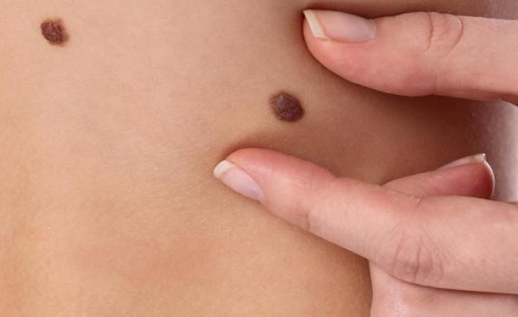 Как выглядит рак кожи: первые симптомы и признаки